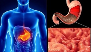 nutrition rules for gastritis